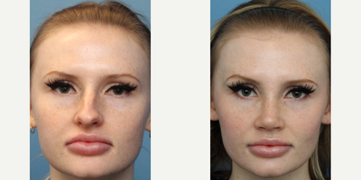 Case 3443 - Woman treated with Rhinoplasty