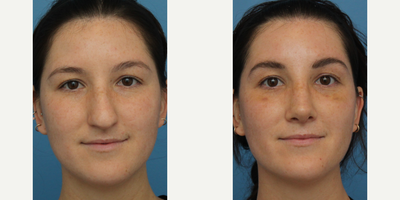 Case 3444 - Woman treated with Rhinoplasty