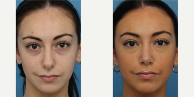 Case 3445 - Woman treated with Rhinoplasty
