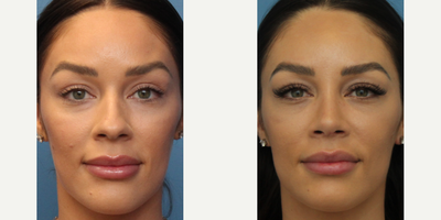 Case 3446 - Woman treated with Rhinoplasty