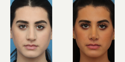 Case 3447 - Woman treated with Rhinoplasty