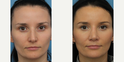Case 3448 - Woman treated with Rhinoplasty
