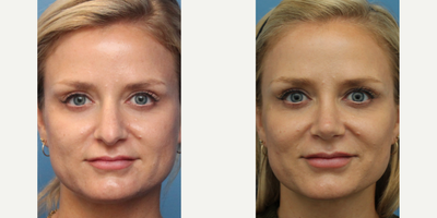 Case 3449 - Woman treated with Rhinoplasty