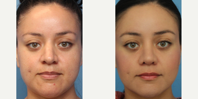 Case 3450 - Woman treated with Rhinoplasty