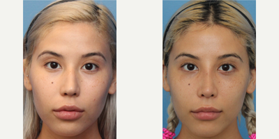 Case 3451 - Woman treated with Rhinoplasty