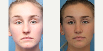 Case 3452 - Woman treated with Rhinoplasty