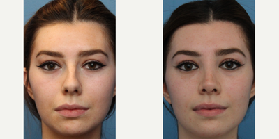 Case 3453 - Woman treated with Rhinoplasty