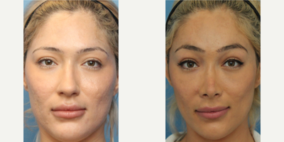 Case 3454 - Woman treated with Rhinoplasty