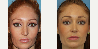 Case 3455 - Woman treated with Rhinoplasty