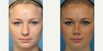 Case 3456 - Woman treated with Rhinoplasty