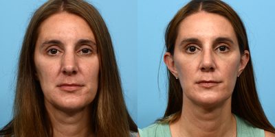 Case 3457 - 35-44 year old woman treated with Rhinoplasty