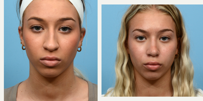Case 3458 - 18-24 year old woman treated with Rhinoplasty