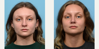 Case 3461 - 18-24 year old woman treated with Rhinoplasty