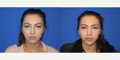 Case 3462 - Woman treated with Rhinoplasty