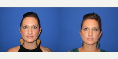 Case 3463 - Woman treated with Rhinoplasty