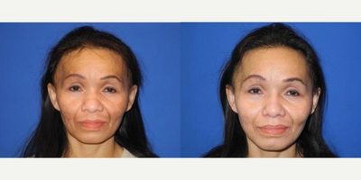Case 3464 - Woman treated with Rhinoplasty