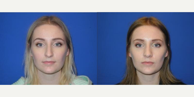 Case 3465 - Woman treated with Rhinoplasty