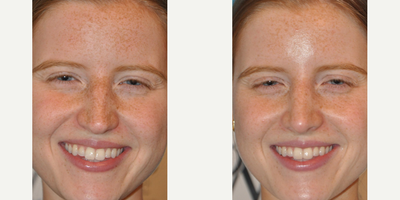 Case 3466 - Woman treated with Rhinoplasty