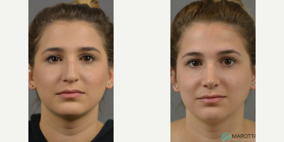 Case 3469 - Woman treated with Rhinoplasty