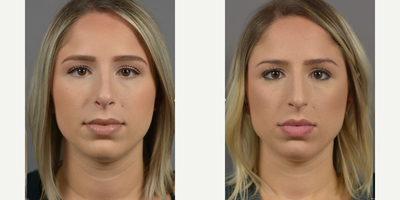 Case 3470 - Woman treated with Rhinoplasty, Septoplasty