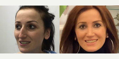 Case 3477 - 38 year old woman treated with Rhinoplasty