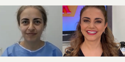 Case 3478 - 47 year old woman treated with Rhinoplasty