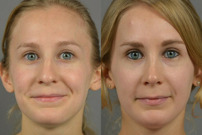 Case 3479 - Woman treated with Rhinoplasty
