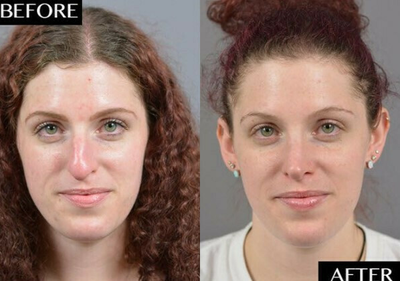 Case 3480 - Woman treated with Rhinoplasty