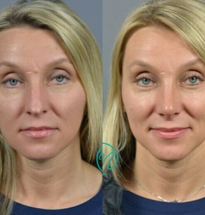 Case 3481 - Woman treated with Rhinoplasty