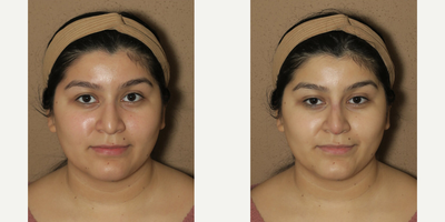 Case 3484 - Woman treated with Rhinoplasty
