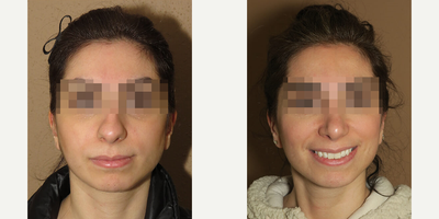 Case 3485 - Woman treated with Rhinoplasty