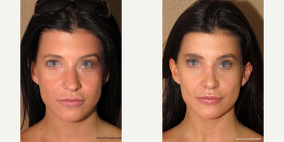 Case 3486 - Woman treated with Rhinoplasty