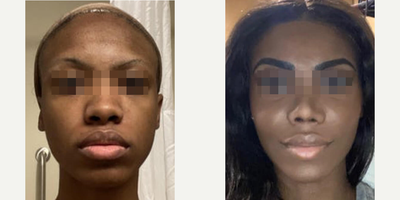 Case 3487 - Woman treated with Rhinoplasty