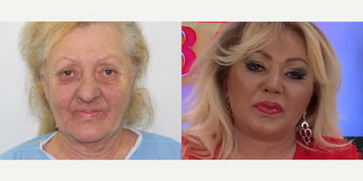 Case 3491 - 73 year old woman treated with Rhinoplasty