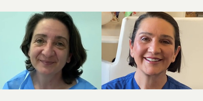 Case 3492 - 50 year old woman treated with Rhinoplasty