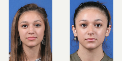 Case 3493 - Rhinoplasty