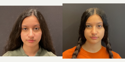 Case 3494 - 18-24 year old woman treated with Rhinoplasty