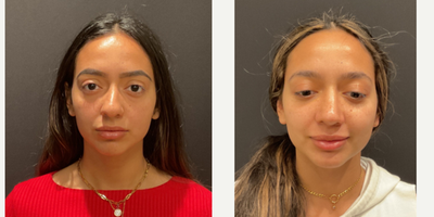 Case 3495 - 18-24 year old woman treated with Rhinoplasty