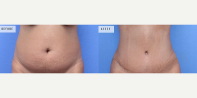 Case 35 - Woman treated with Tummy Tuck