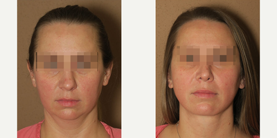 Case 3505 - Woman treated with Rhinoplasty