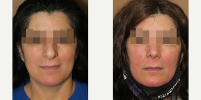 Case 3506 - Woman treated with Rhinoplasty