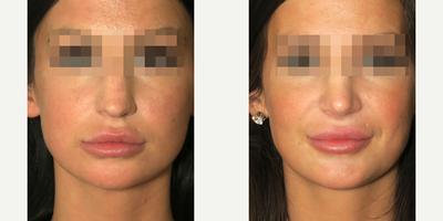 Case 3507 - Woman treated with Rhinoplasty