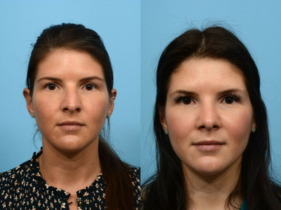 Case 3508 - 25-34 year old woman treated with Rhinoplasty