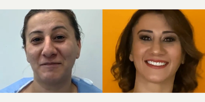Case 3510 - 36 year old woman treated with Rhinoplasty