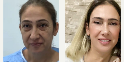 Case 3511 - 48 year old woman treated with Rhinoplasty 