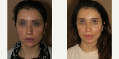 Case 3515 - Woman treated with Rhinoplasty