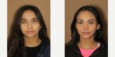 Case 3516 - Woman treated with Rhinoplasty