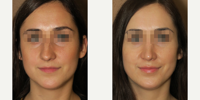 Case 3517 - Woman treated with Rhinoplasty