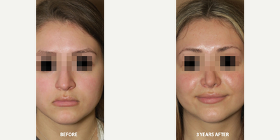 Case 3518 - Woman treated with Rhinoplasty