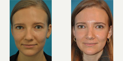 Case 3519 - Woman treated with Rhinoplasty